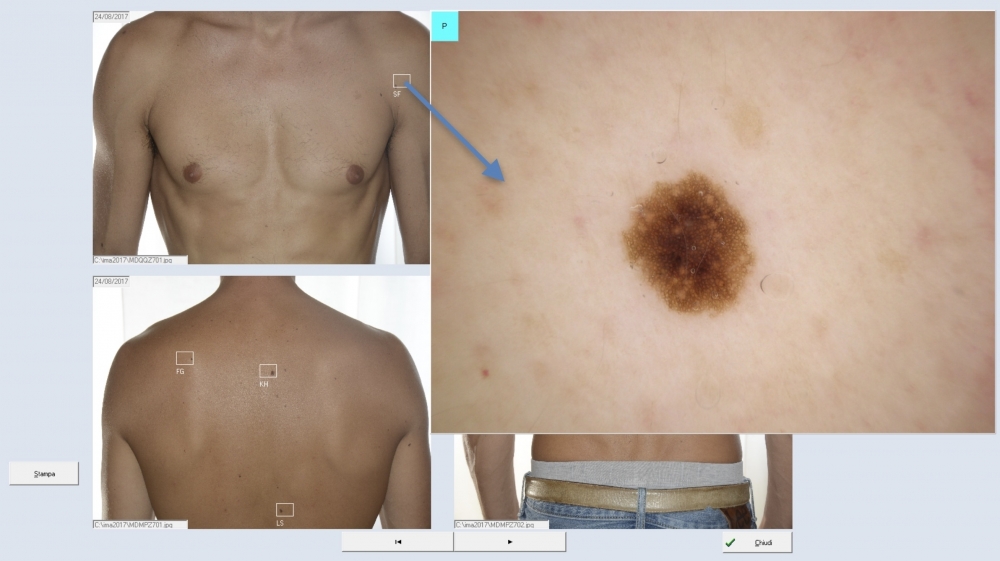 Total Body ed individuazione - Software DDAX3 e Video Dermatoscopi HD Dell'Eva-Burroni